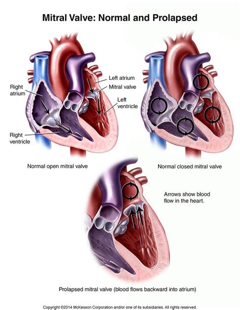 Pin By Nonas Arc On Mitral Valve Prolapse Mvp Mitral Valve Mitral