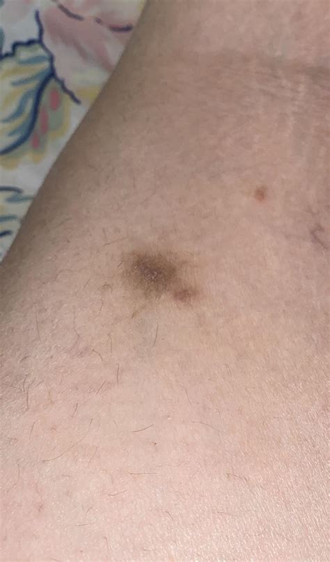 Ive Had This Dark Spot On The Back Of My Leg For A Couple Months Now