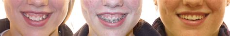 Case Study 62 Gummy Smile Bandeen Orthodontics Battle Creek