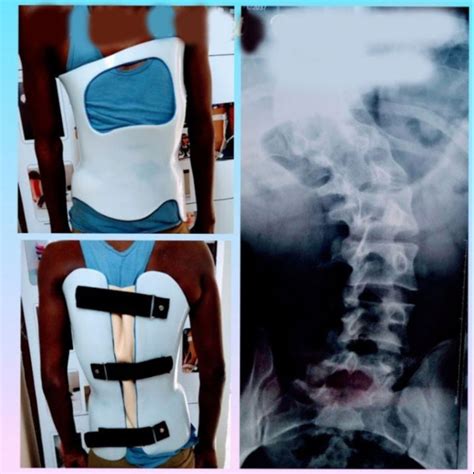 Scoliosis Boston Brace बोस्टन ब्रेस In Motion Prosthetic And Orthotic