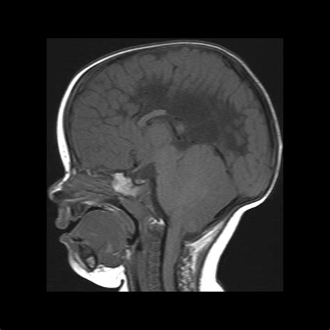 Infant Status Post Myelomeningocele Repair Pediatric Radiology Case