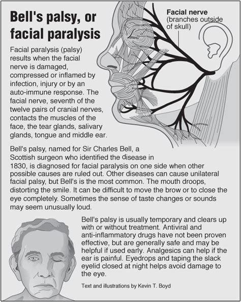 Bells Palsy Or Facial Paralysis Bells Palsy Bells Palsy