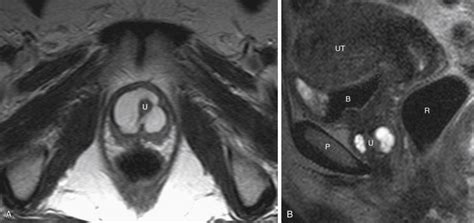 Pelvic Pain Lower Urinary Tract—urethral Diverticulum Cysts And