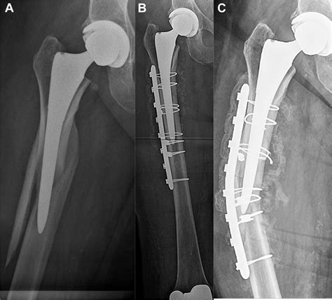 Periprosthetic Femur Fractures After Total Hip Arthroplasty Does The