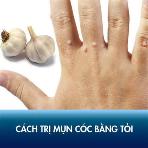 3 Cách Trị Mụn Cóc Bằng Tỏi Với Mẹo Dân Gian Hiệu Quả Nhanh