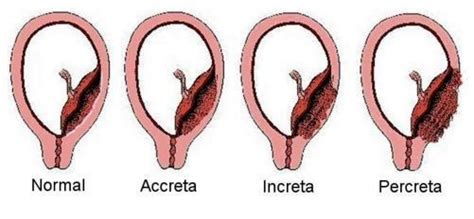 Placenta Accreta What Is Symptoms Risk Factors Diagnosis