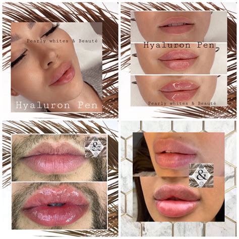 Hyaluron Pen Lip Fillers In 2021 Lip Fillers Injectables Fillers Lips