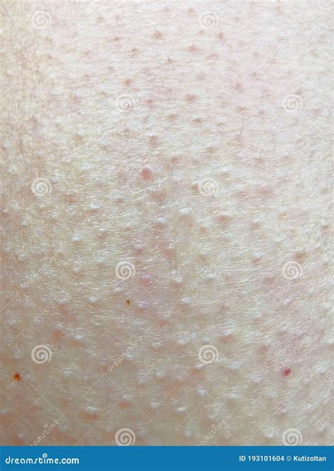 Goosebumps On Human Skin Stock Photo Image Of Skin 193101604