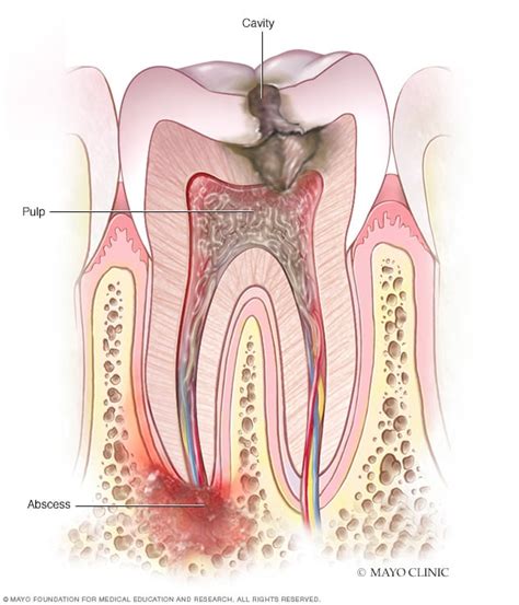 This web page explains how the tooth decay process starts and how it can be stopped or even reversed to keep your child from getting cavities. Tooth abscess - Symptoms and causes - Mayo Clinic