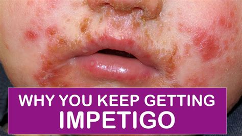 What You And Your Doctor Should Be Doing To Stop Getting Impetigo Youtube