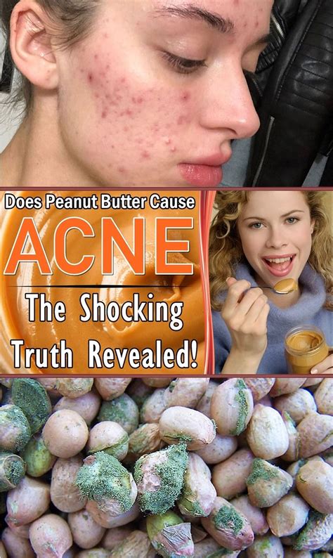 Does Peanut Butter Cause Acne Peanut Butter Acne Butter