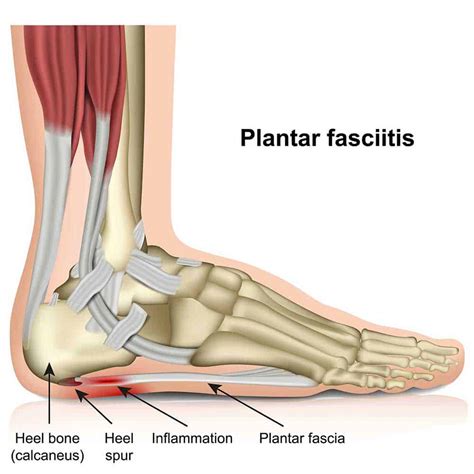 Heel Pain Plantar Fasciitis Causes Treatments And Prevention Injury Health Blog