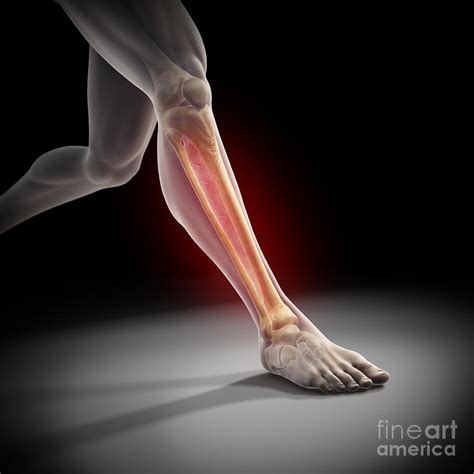 Medial Tibial Stress Syndrome Photograph By Science Picture Co Fine