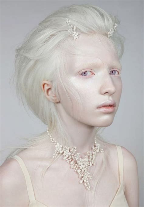 Woman With Albinism Albino Model Albino Girl Albinism