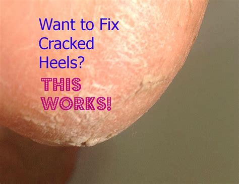 Chapped lips, dry feet and itchy hands. Gluten Free A-Z : Have Cracked Heels? This works