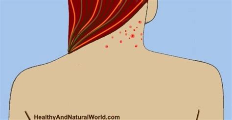 Pimples On Neck How To Effectively Treat Neck Acne Based On Science