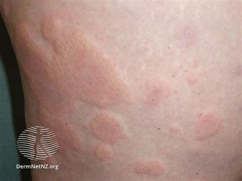 Skin Allergy Identifying 3 Common Skin Rashes