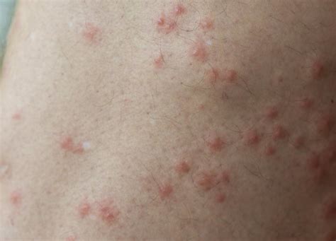 When my mother finds an itchy bump on my skin, she often claims it is a spider bite. Insect bites: Reactions, types, and images