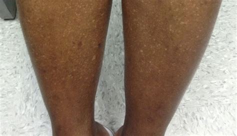 Why Am I Getting Light Spots On My Legs