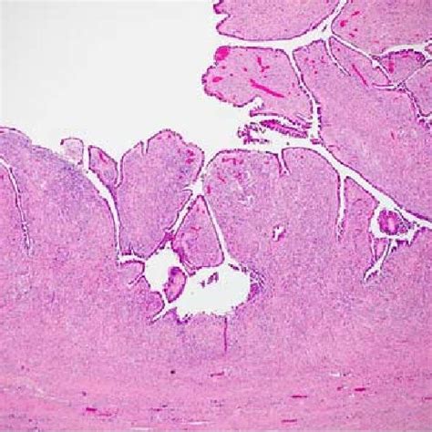 Photomicrograph Of An Ovarian Tumor Showing Papillary Projections With