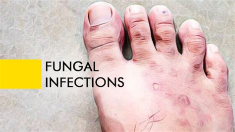 Fungal Infections Natural Remedies For Men And Women