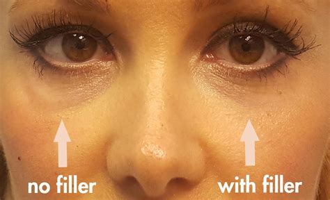 Under Eye Filler Before And After 3