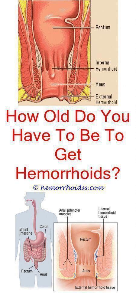 For internal hemorrhoids and some external hemorrhoids, dr. Pin on Painless Way To Remove Skin Tags