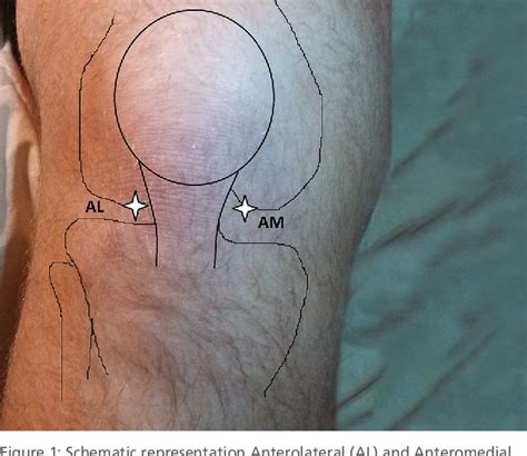 Figure 1 From Approach To Knee Injections A Review Of The Literature Semantic Scholar