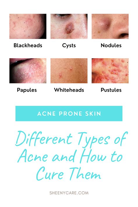 How To Treat Acne Papules Howotremov