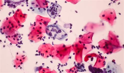 , correction can be found in ann oncol 2018 oct 1;29(supplement_4):iv262. New microarray could improve cervical cancer diagnosis ...