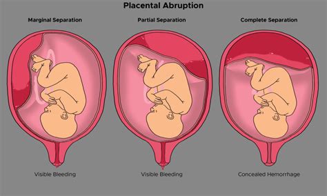 Figure Illustration Of Placental Abruption Marginal Statpearls
