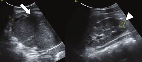 Ultrasound Abdomen Showing Bilateral Wilms Tumor Presenting As A Solid