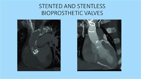 Stented Bioprosthetic Aortic Valve With Radiopaque Stent Base Ring And
