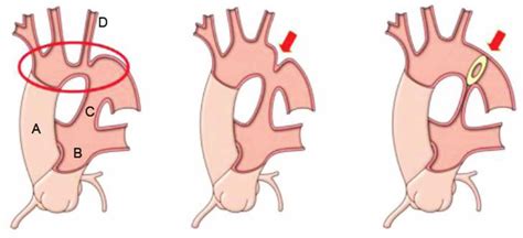 Anestesia y Coartación de Aorta Coarctation of the Aorta WFSA Resources