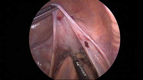 Such symptoms have been collectively referred to as low anterior resection syndrome (lars). Single Port Laparoscopic Low Anterior Resection (TaTME ...