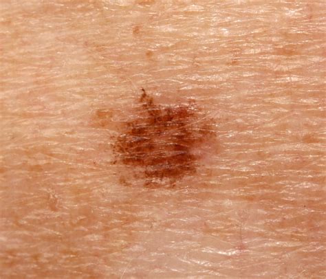 When Brown Mole Turns Red Melanoma Or Nothing To Worry About Scary