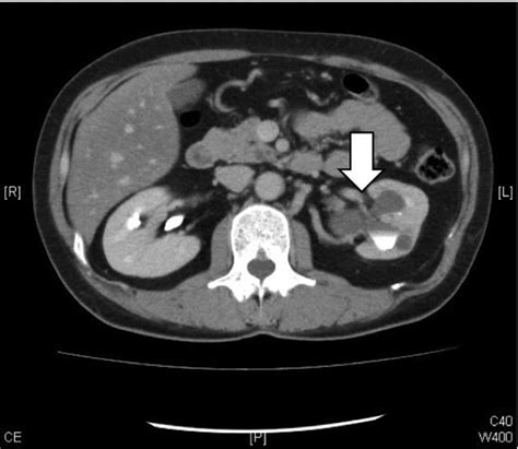 Hydronephrosis Ct Scan