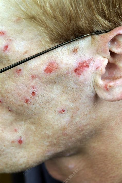 Infected Self Inflicted Skin Lesions Stock Image C0197578