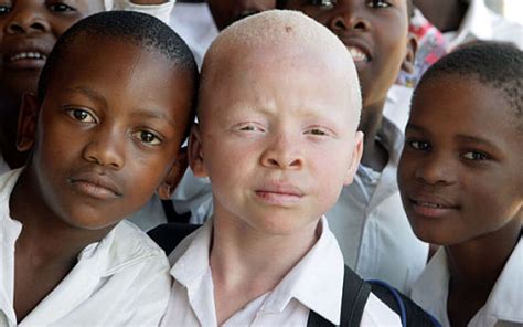 Protecting People With Albinism In Tanzania
