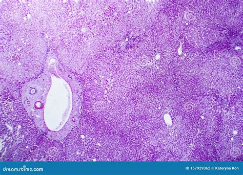 Cloudy Swelling Of The Liver Light Micrograph Stock Photo Image Of