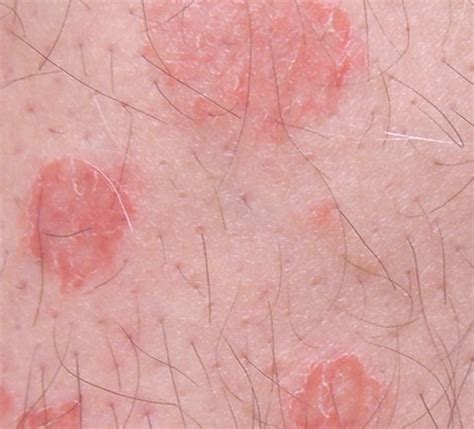 Nummular Eczema Pictures Causes Symptoms Treatment