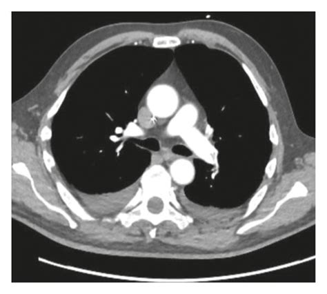 Contrast Enhanced Computed Tomography Of The Chest Demonstrating A