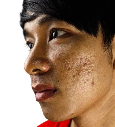 636 Skin Diseases Face Stock Photos Free And Royalty Free Stock Photos