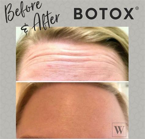 Can i treat my own acne? Botox Before & After | Botox