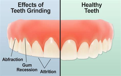 How Can Teeth Grinding Affect Your Health