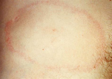 Figure 03128938 Typical Features Of Erythema Migrans A Sign Of The