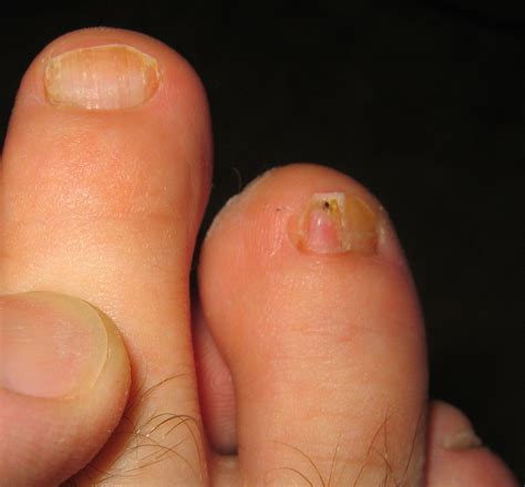 Infections Caused By Common Fungus Clear Toes Clinicclear Toes Clinic