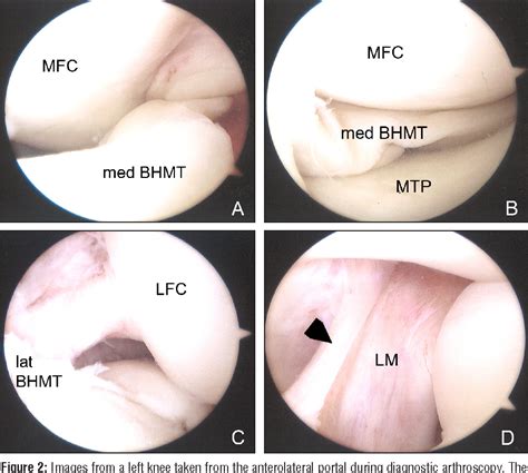 Meniscus tears are extremely common knee injuries. Figure 2 from Displaced Medial and Lateral Bucket Handle ...