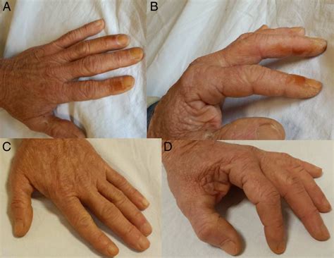 Tinea Nigra On The Fingers Bmj Case Reports