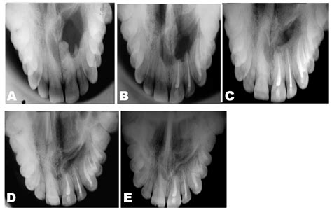 Full Text Management Of An Impacted Inverted Mesiodens Associated
